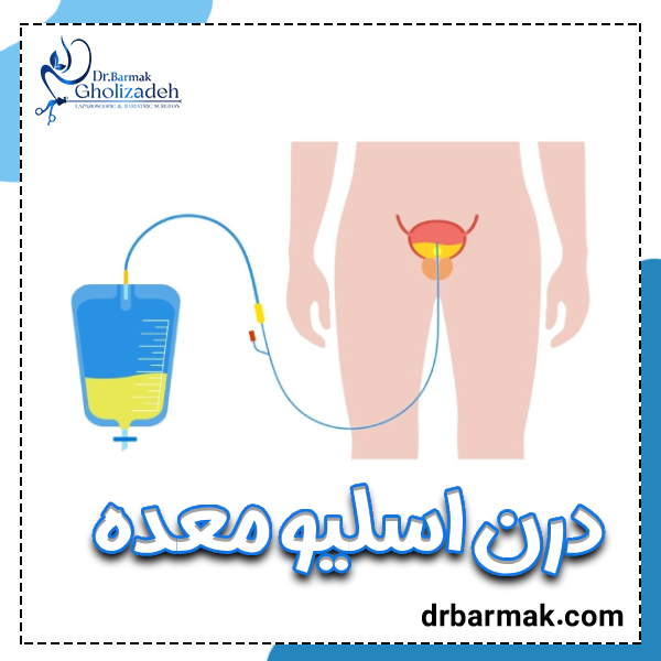درن اسلیو معده - دکتر قلی زاده