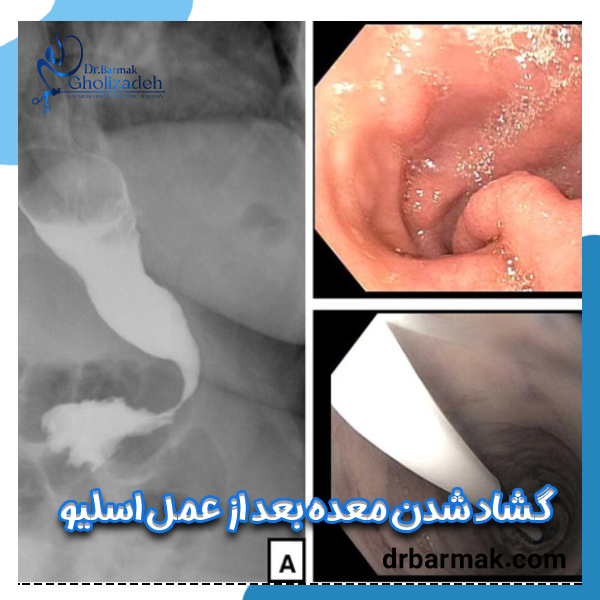 گشاد شدن معده بعد از عمل اسلیو - دکتر برمک قلی زاده