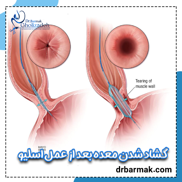 گشاد شدن معده بعد از عمل اسلیو - دکتر برمک قلی زاده