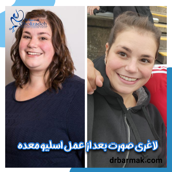 لاغری صورت بعد از اسلیو معده - دکتر برمک قلی زاده