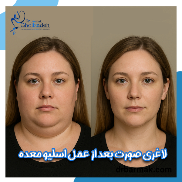 لاغری صورت بعد از اسلیو معده - دکتر برمک قلی زاده