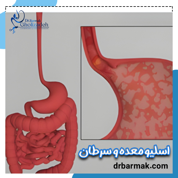 اسلیو معده و سرطان - دکتر برمک قلی زاده