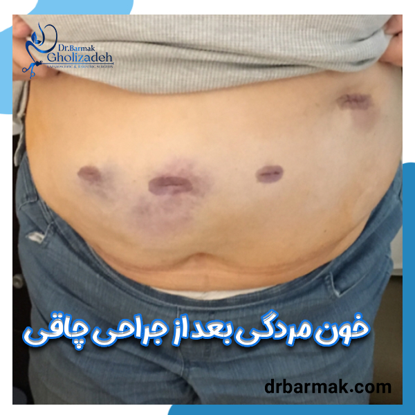 خون مردگی بعد از جراحی چاقی - دکتر برمک قلی زاده