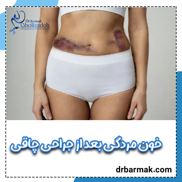 خون مردگی بعد از جراحی چاقی - دکتر برمک قلی زاده