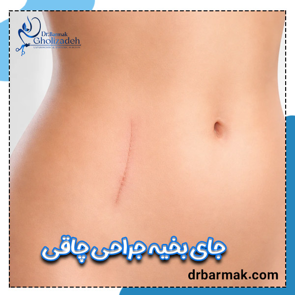 جای بخیه جراحی چاقی - دکتر قلی زاده