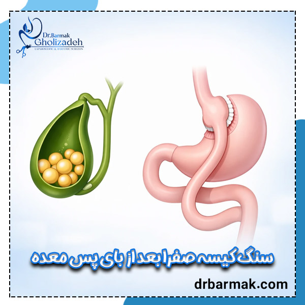 سنگ کیسه صفرا بعد از بای پس معده - دکتر قلی زاده