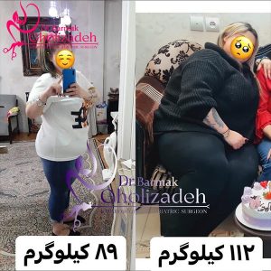 تغییرات بعد از عمل اسلیو با دکتر قلی زاده