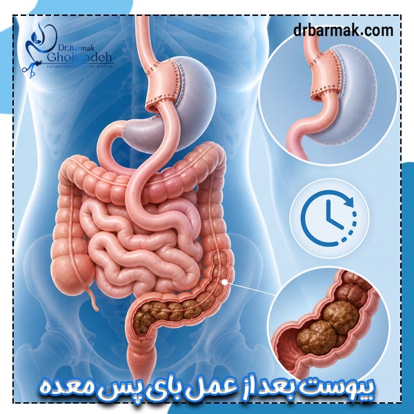 یبوست بعد از عمل بای پس معده - دکتر قلی زاده